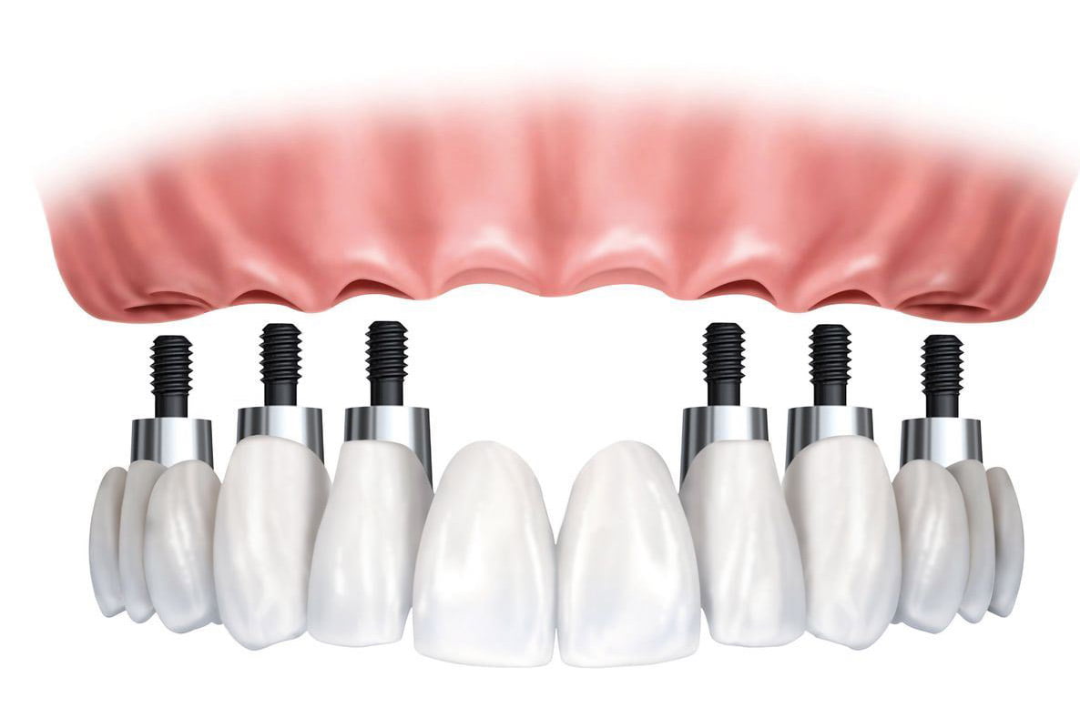 implantologia carico immediato studio odontoiatrico